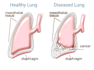 How do I know if i have mesothelioma